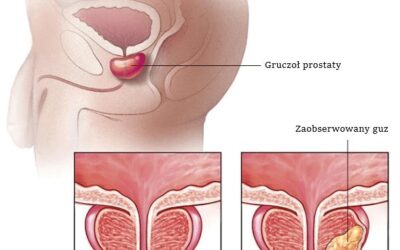 Rak prostaty objawy, diagnostyka, rokowania, leczenie
