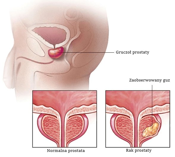 Rak prostaty objawy, diagnostyka, rokowania, leczenie